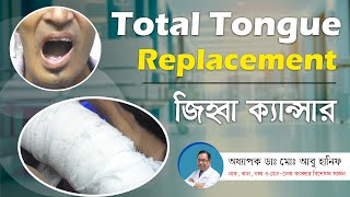 Total Tongue Replacement। জিহ্বা ক্যান্সার। Prof Dr Md Abu Hanif [upl. by Eirlav798]