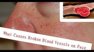 What Causes Broken Blood Vessels on Face [upl. by Yarled]