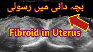 Fibroid UterusSubserosal fibroidUltrasound course [upl. by Womack]