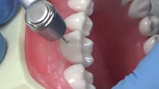 Cl I buccal pit lower 1st molar part 2 [upl. by Eojyllib]