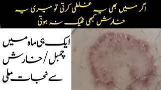 Ringworm kharish Tinea Crurisداد خارش چمبل Fungal Infection Ka Elaj [upl. by Desdamona]