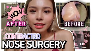 CONTRACTED NOSE REVISION RHINOPLASTY  KOREAN PLASTIC SURGERY VLOG PT1 [upl. by Leviralc731]