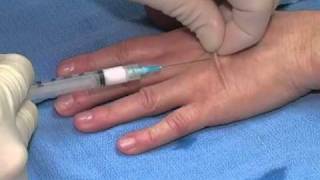 Dr Bidic Performs Hand Rejuvenation with Sculptra and Radiesse [upl. by Corkhill]