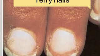 Quick review of Paronychia  Clubbing of fingers Melanonychiaonycholysis terry nails  pitting [upl. by Alomeda485]