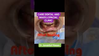 Enucleation of Radicular cyst irt lower anterior teeth [upl. by Alton]