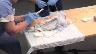 Using a Meconium Aspirator [upl. by Ymmot]