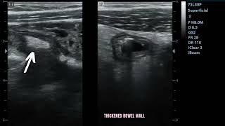 Ultrasound showing Enterocolitis [upl. by Enirehtac341]