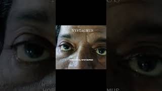 NYSTAGMUS  HORIZONTAL NYSTAGMUS eye ophthalmology [upl. by Elliot]