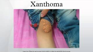 Xanthoma [upl. by Faline]