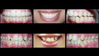 Invisalign for Treating Crowding Teeth and Crossbite at Cosmetic Dental Associates [upl. by Crutcher]