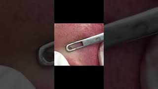 Dr Pimple Poppers Gnarly Pops Part 1 [upl. by Issirk]