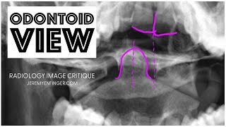 Radiology Image Critique Odontoid View [upl. by Amarette]