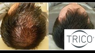 Tricopigmentazione infoltimento caduta capelli calvizie  ALOPECIA PERDITA CAPELLI [upl. by Demaria]