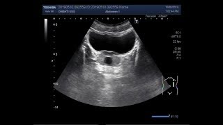 Ultrasound Video showing a prostatic utricle cyst [upl. by Calhoun]