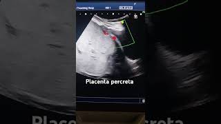 placenta percreta baby radiological mother health life anomaly ultrasound [upl. by Idnas]