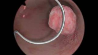 Polypectomy  Polyp Removal  Virtual Reality Simulation for Endoscopic Surgery [upl. by Dnumde500]