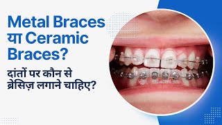 Metal Braces या Ceramic Braces  दांतों पर कौन से ब्रेसिज़ लगाने चाहिए [upl. by Gierc17]