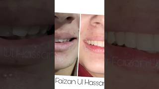 Ceramic braces minimal Treatment big change viralbraces orthodontist smile shorts [upl. by Pegg436]