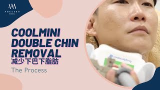 Coolmini Double Chin Removal  The Process [upl. by Rossi]