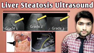 Liver Steatosis Ultrasound  Grade 1 Fatty Changes in liver in hindi by Ali Waqar [upl. by Sumahs365]