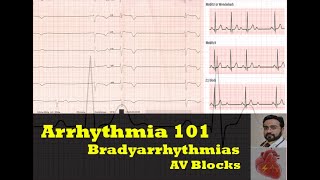 Arrhythmia 101 Bradyarrhythmias  AV Blocks [upl. by Aelyak625]