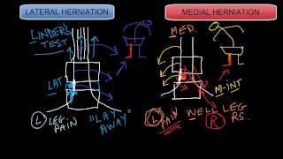 Lateral vs Medial Disc Herniations [upl. by Chrisse]