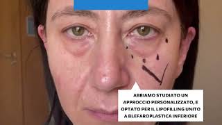 Oculoplastica  Lipofilling e blefaroplastica inferiore [upl. by Freida]