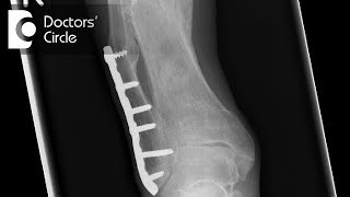 How can one manage malunion of Tibial Fracture after 6 months Dr Mohan M R [upl. by Banks472]