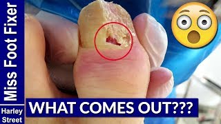 How to Treat Paronychia by Miss Foot Fixer Marion Yau [upl. by Giule109]