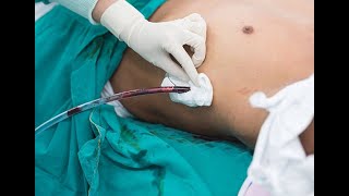 Chest drain tube intercostal tube thoracostomy procedure [upl. by Aluin277]