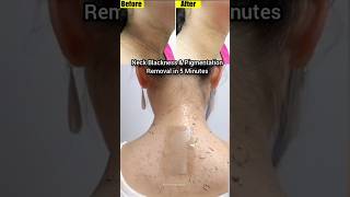 Neck Blackness Remove tips  Remove neck pigmentation  Dark neck removal at home drmenkavarma [upl. by Oratnek117]