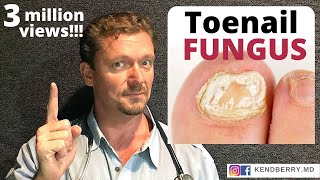 CURE Toenail Fungus And keep it Gone FOREVER [upl. by Aiekan]