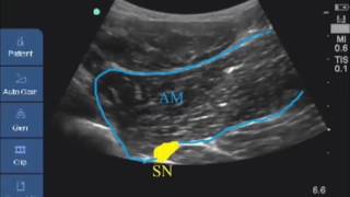 adductor muscle and sciatic nerve anterior [upl. by Malchy]