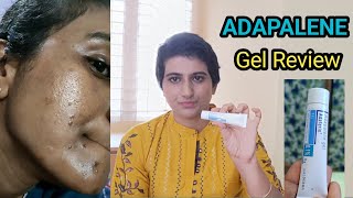 adapalene gel review telugu  adaferin gel for acne commedones and acne marks How to use adapalene [upl. by Tabby401]