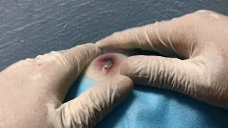 Grossest Most Disgusting Pimples and Pops EVER [upl. by Salisbarry899]