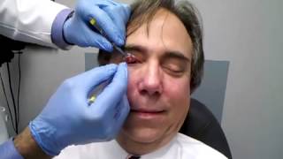 More Eye Surgery DrSteve Gets a Chalazion Removed [upl. by Ciardap]