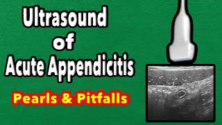 Ultrasound of Acute Appendicitis Pearls and Pitfalls [upl. by Yrred]