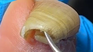 Extremely long ingrown toenailsThe patient has not had a pedicure for 4 months【Xue Yidao】 [upl. by Elbag]