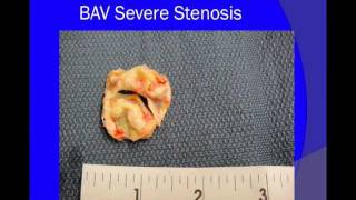 Aortic Valve Stenosis [upl. by Tjon]