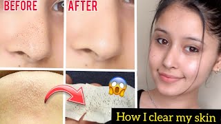 Get Rid of BlackheadsWhiteheads Clogged Pores 😍Just in 1 day DEEP CLEANSING ROUTINE [upl. by Tsirc195]