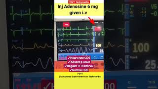 PSVT Reverted by inj Adenosine l Tachycardia ecg palpitation shorts [upl. by Hbahsur]