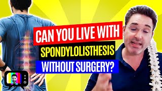 11Can you live with spondylolisthesis without surgery [upl. by Ahsitahs]