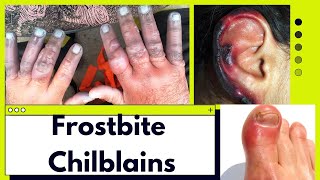 Frostbite in Hindi Def Cause Symptoms Risk factor Treatment [upl. by Nelrsa]