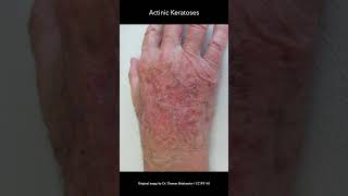 Actinic Keratosis [upl. by Bride]