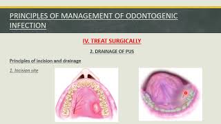 Fall 2020  Oral surgery 3  Lec 1  Orofacial infection [upl. by Luht139]