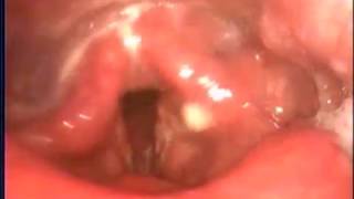 急性咽喉炎與膿痰 聲帶水腫 劉耿僚 acute laryngopharyngitis amp laryngeal edema [upl. by Reiche]