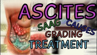 What are Ascites Transudate vs Exudate  SAAG  Fluid Wave Test  Shifting Dullness  Treatment [upl. by Caneghem887]