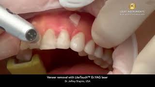 Veneer removal with LiteTouch™ ErYAG laser [upl. by Purpura]