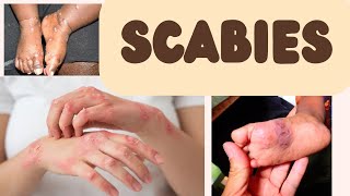 Scabies  dermatological conditions  Medical surgical nursing  management amp prevention [upl. by Karna625]