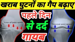 घर बैठे घुटनों का गैप बढ़ाने का सबसे आसान तरीकाKnee Osteoarthritis Treatment [upl. by Adnilav831]